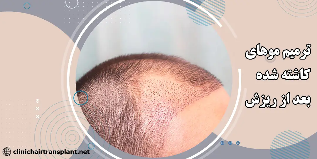 ترمیم موهای کاشته شده بعد از ریزش شوک