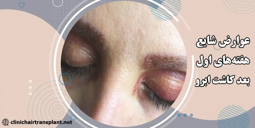 عوارض شایع در هفته‌های اول بعد از کاشت ابرو