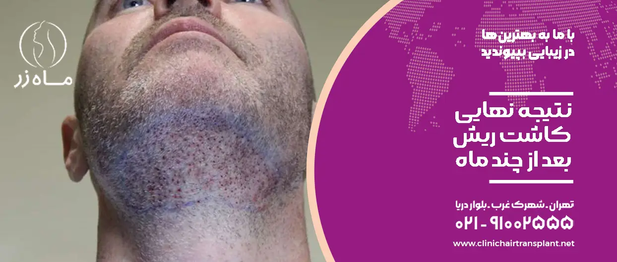 نتیجه نهایی کاشت ریش بعد از چند ماه