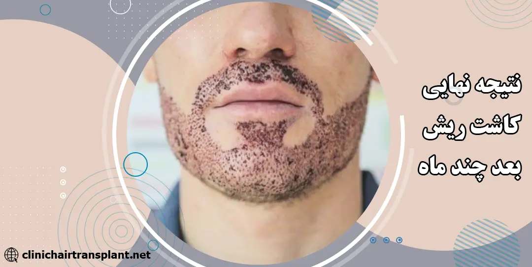 نتیجه نهایی کاشت ریش بعد چند ماه