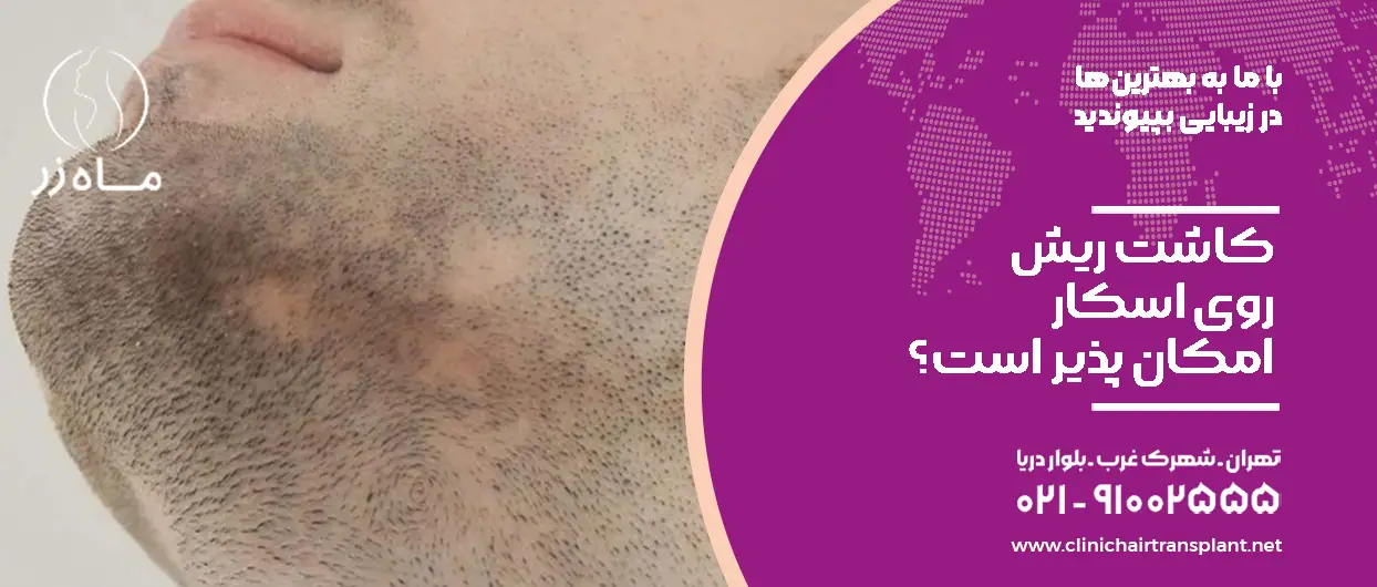 کاشت ریش روی اسکار امکان پذیر است؟