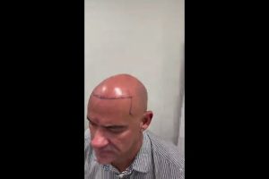 کاشت-مو-برای-موهای-کم-پشت-چگونه-است؟-poster