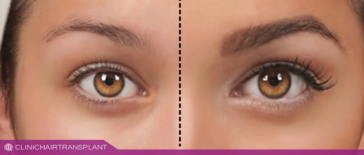 ارتباط بین هورمون‌‌های کلیدی بر کاشت ابرو