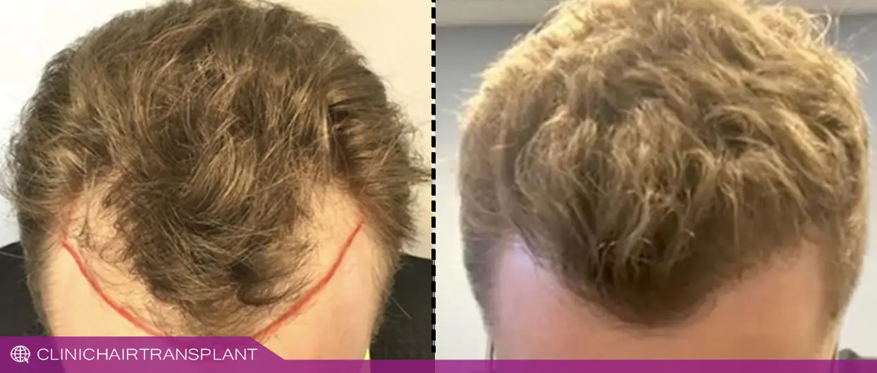 بعد از چه مدت از کاشت مو نتایج قابل مشاهده است؟