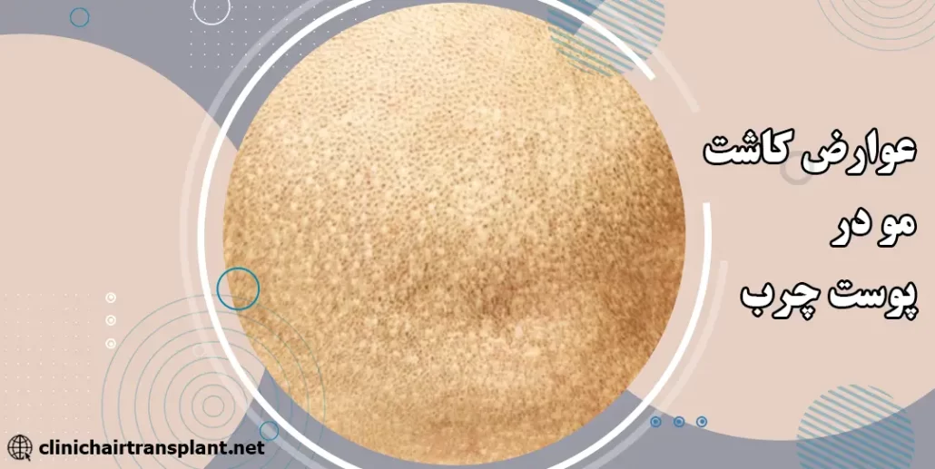عوارض احتمالی کاشت مو در پوست چرب