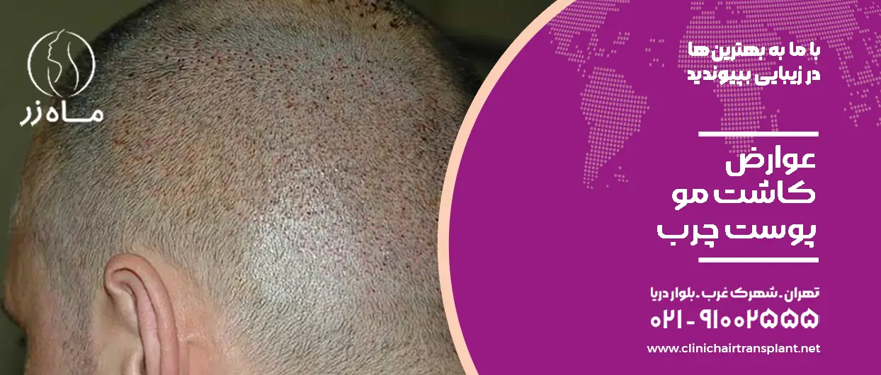 عوارض کاشت مو پوست چرب