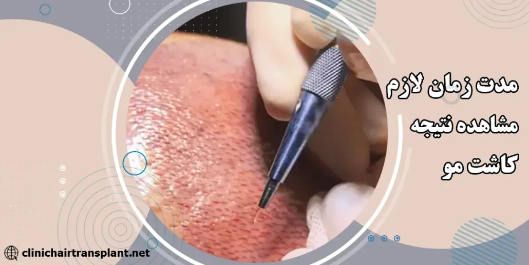 مدت زمان لازم برای مشاهده نتیجه کامل کاشت مو
