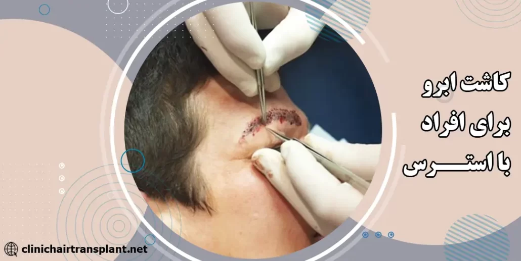 کاشت ابرو برای افرادی که سابقه ریزش استرسی دارند