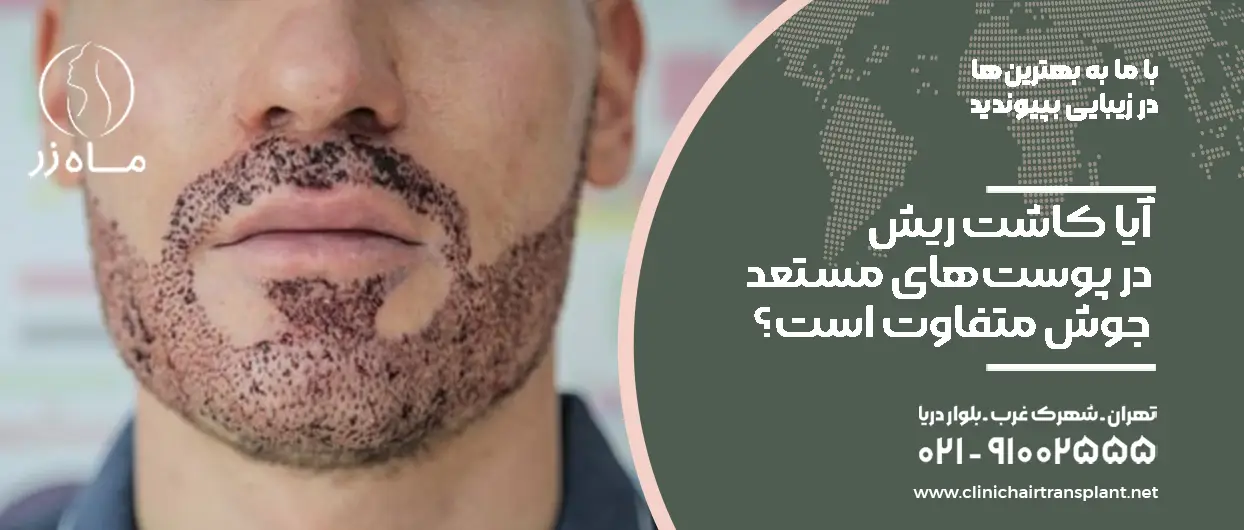 آیا کاشت ریش در پوست‌های مستعد جوش متفاوت است؟