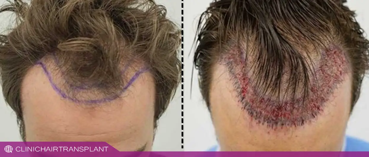 آیا کاشت مو خون رسانی ضعیف نتیجه بخش است؟