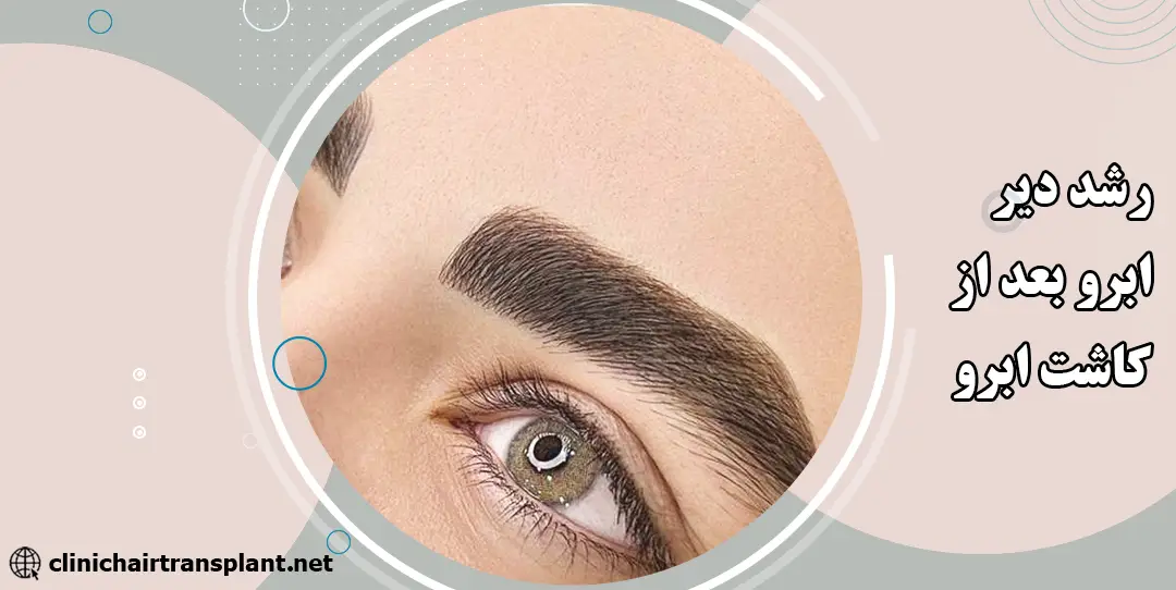 رشد دیر ابرو بعد از کاشت