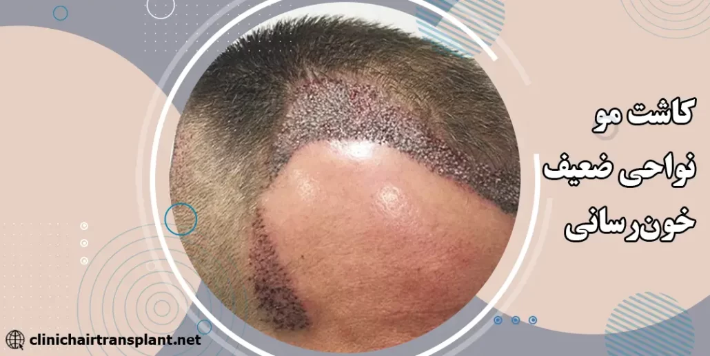 کاشت مو در نواحی با خون‌رسانی ضعیف