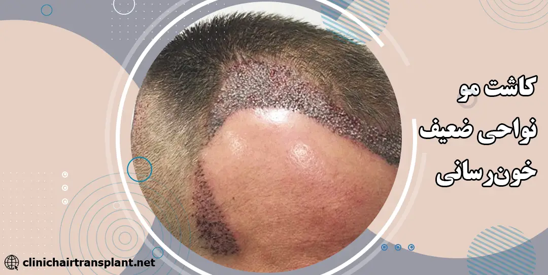 کاشت مو در نواحی با خون‌رسانی ضعیف