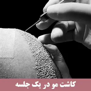 کاشت مو میکروگرافت