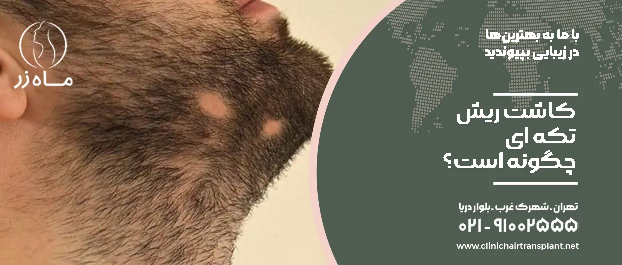 کاشت ریش تکه ای چگونه است؟