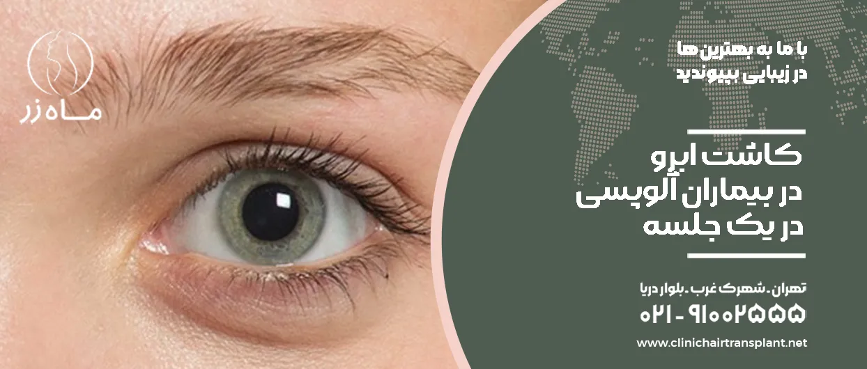 کاشت ابرو برای آلوپسی