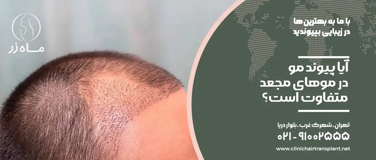 آیا پیوند مو در موهای مجعد متفاوت است؟