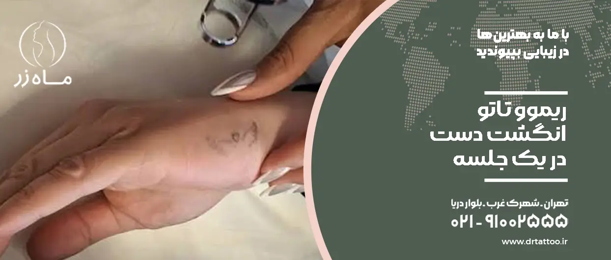 ریموو تاتو انگشت دست